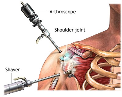 Best Robotic Partial Knee Replacement in India